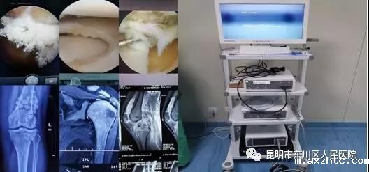 伟德BETVLCTOR网址外二科开展新技术 美国施乐辉关节镜系统投入使用
